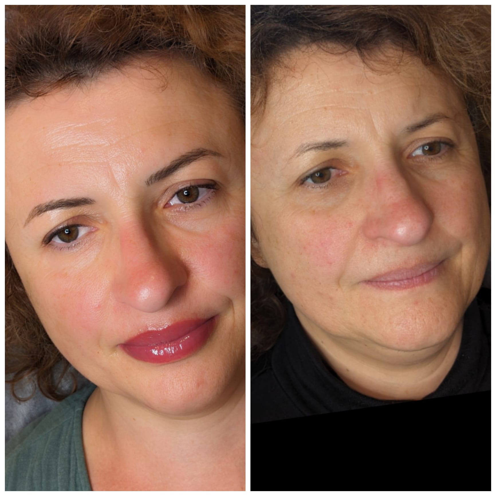 Vorher-Nachher einer Lippenpigmentierung mit betonter Kontur